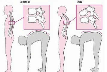 上海强直性脊柱炎医院